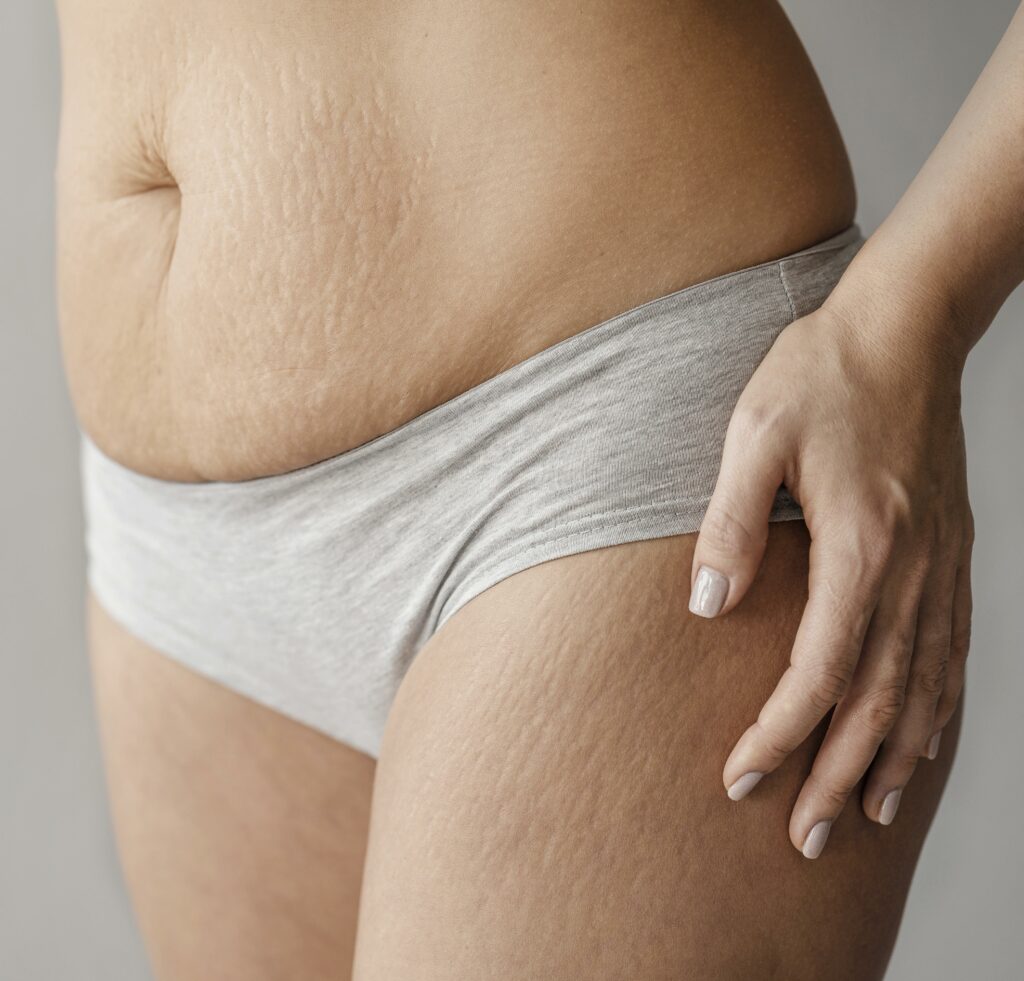 L'Ozonoterapia un valido metodo per combattere la cellulite.
